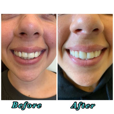 Porcelain Veneers Gone Wrong, what to do? - Sola Dental Spa