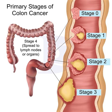 Colon Polyp and Cancer - Digestive and Liver Health Specialists