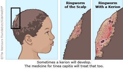 Ringworm (for Parents) | Nemours KidsHealth