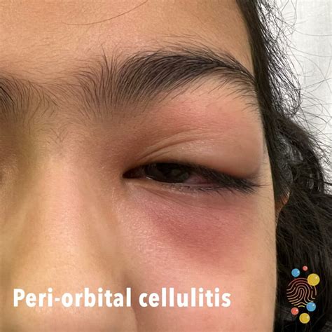 Periorbital Cellulitis – NBKomputer