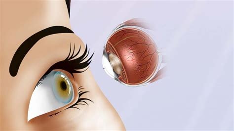 Why Is There A High Growth Visibility for Artificial Cornea & Corneal ...