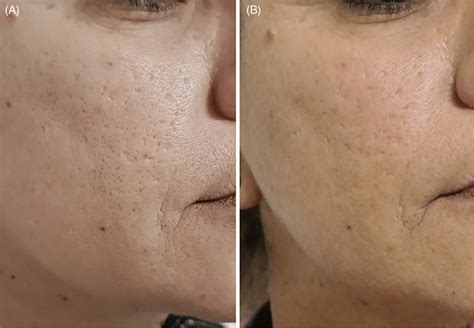 Treatment of acne scars with fractional laser (two sessions). (A ...