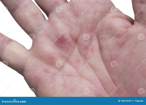 HFMD - Hand Foot And Mouth Disease - Viral Diseases Stock Image | CartoonDealer.com #84113701