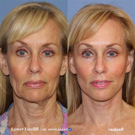 Lower Facelift vs. Neck Lift: What’s the Difference? | Neck lift, Face ...