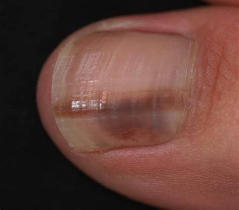 Subungual Melanoma Fingernail