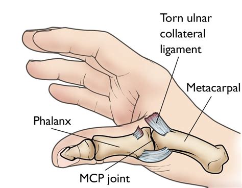 Sprained Thumb - OrthoInfo - AAOS