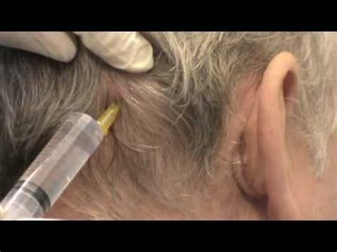 Greater Occipital nerve injection technique | Occipital nerve block ...