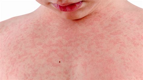 Rash on Chest Pictures, Causes, Symptoms, Remedies and Treatment ...