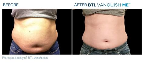 VANQUISH | NON-INVASIVE FAT REDUCTION IN SOMERS, CT