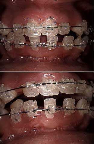 Orthodontic drifting means mesial drift or tipping