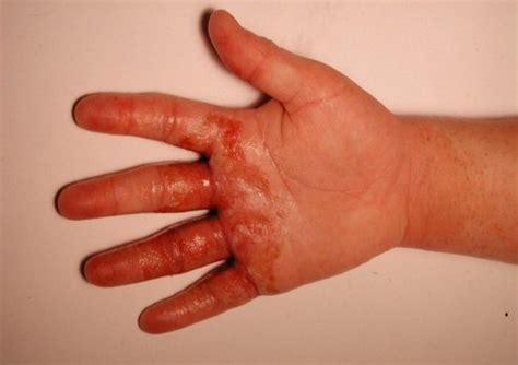 Weeping Eczema - Home Remedies, Causes & Symptoms