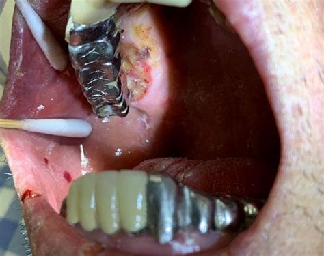 Oral Myiasis Causes Signs Symptoms And Treatment Para - vrogue.co