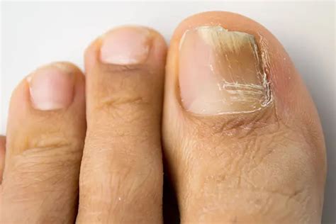 Causes and Treatments of Toenail Fungus | LifeMD