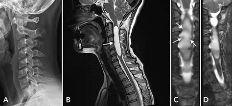 Cureus | Multicentric Spinal Pilocytic Astrocytoma Presenting with Syringomyelia