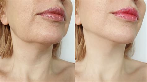 How A Lymphatic Massage Can Get Rid Of Your Double Chin