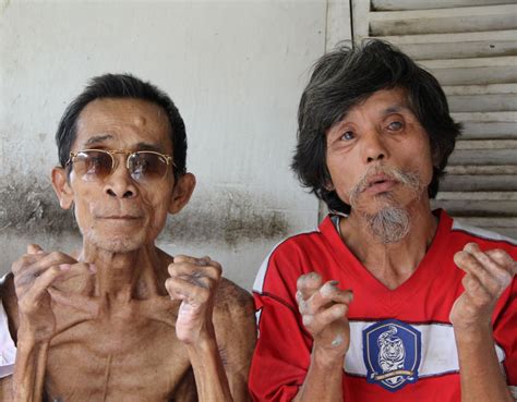 The New Humanitarian | Facing the stigma of leprosy