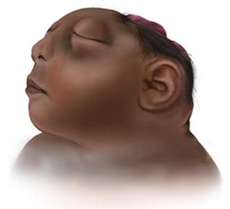 Anencephaly: MedlinePlus Genetics