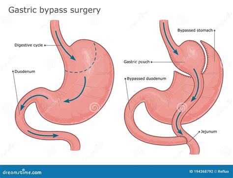 Gastric bypass surgery stock vector. Illustration of diagram - 194368792