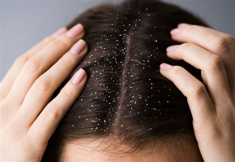 Best Dandruff Treatment | Know The Causes And Solution