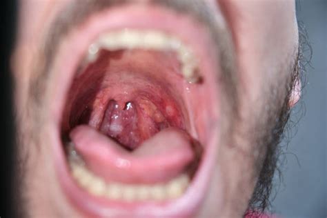 Throat Ulcers Stock Photos, Pictures & Royalty-Free Images - iStock