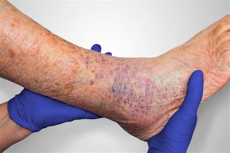 Wound Assessment and Documentation (Microlearning) - Medline