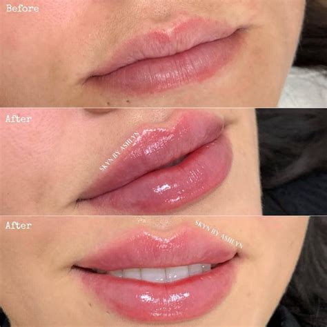 Best Lip Filler Brands: Top 10 Picks For Plumping Perfection