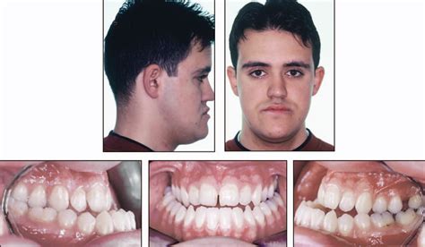 Figure 2 from Seven Years of Retention of Severe Mandibular Prognathism Treated With Bimaxillary ...