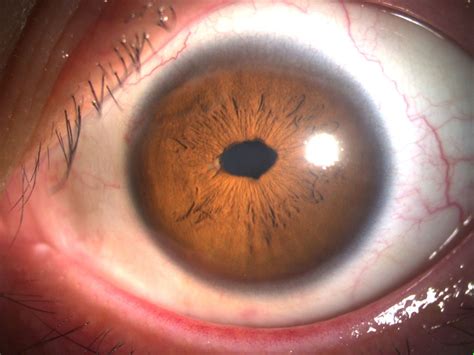 Anterior segment photographs of the left eye on postoperative day 1... | Download Scientific Diagram