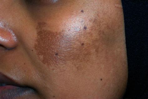 An Overview of Melasma (2022)