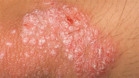 FDA Approves Topical PDE4-Inhibitor Roflumilast for Psoriasis