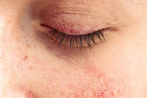 Ocular Rosacea: Symptoms, Causes & Treatment | MyVision.org