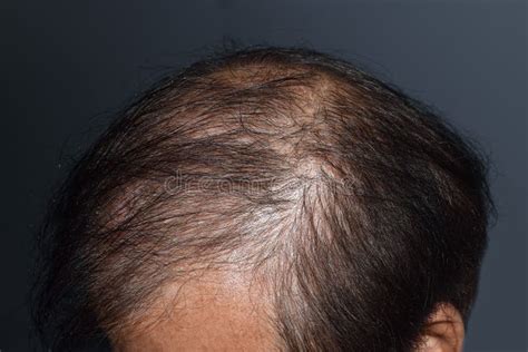 Thinning or Sparse Hair, Male Pattern Hair Loss Stock Image - Image of ...