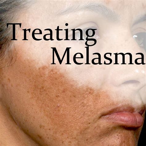 Melasma Treatment - laser treatment for skincare | Dr Sin Yong