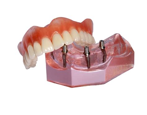 Model All-on-4 denture - Sunrise Dental Blog