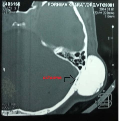 CT scan showing the osseous outgrowth over the left mastoid. | Download Scientific Diagram