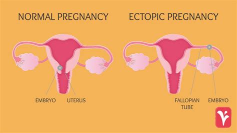 Ectopic Pregnancy - Santripty also called a tubal pregnancy