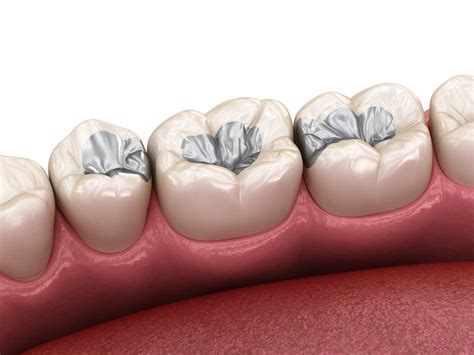 Replace Metal Fillings in Alamo Ranch | Alamo Springs Dental