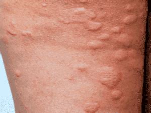 Hives (Urticaria) | Harley Street Dermatology Clinic