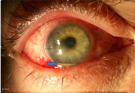 Cureus | Postoperative Endophthalmitis After Cataract Surgery: An Update