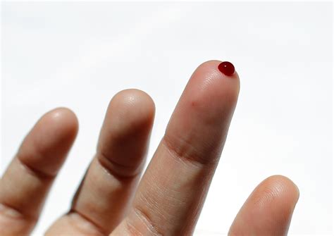 Share more than 117 blood clot under nail latest - ceg.edu.vn