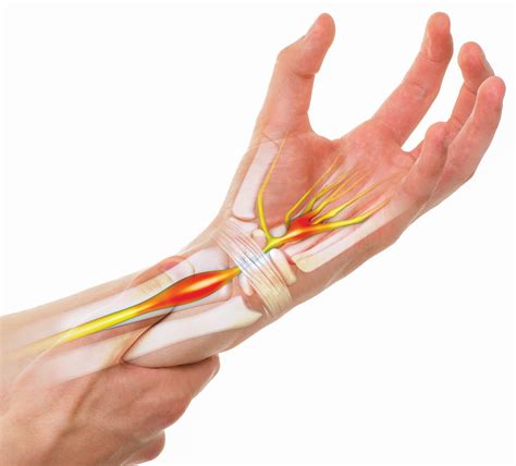 Understanding Carpal Tunnel Syndrome