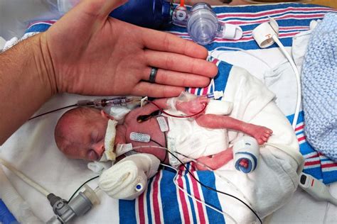 Miraculous Micro-Preemie Baby Shocks the World - Mommy Underground