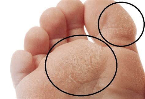 Diabetic Foot Infection | Symptoms, Causes and Treatment