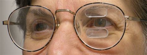 Peripheral prism glasses help hemianopia patients get around