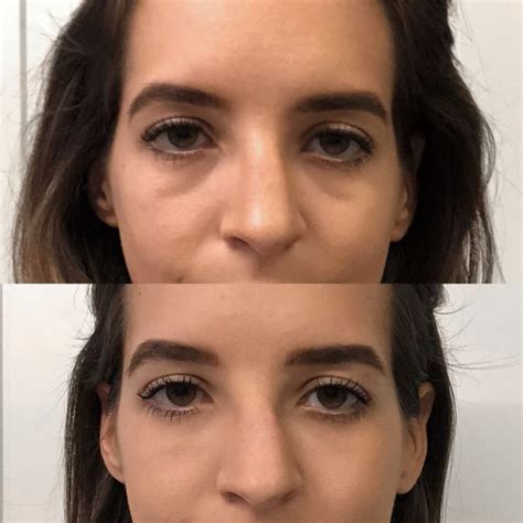 Under Eye Fillers/ Dark Circle Reduction Before and After photos Dallas ...