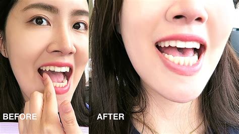How To Fix Vampire Teeth - Elevatorunion6