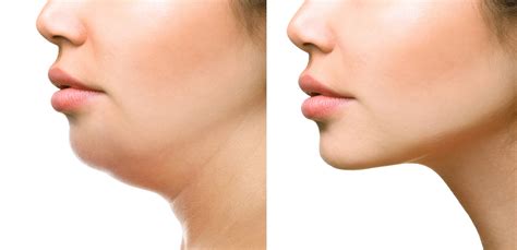 GET RID OF NECK FAT OVERNIGHT WITH THIS REMEDY - Health GadgetsNG