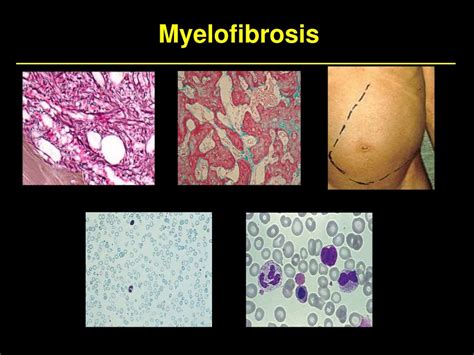 Treatment of High Risk Myelofibrosis.