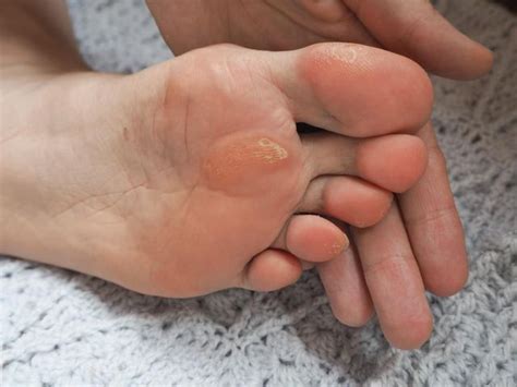 Understanding Calluses: Causes, Prevention, and Treatment