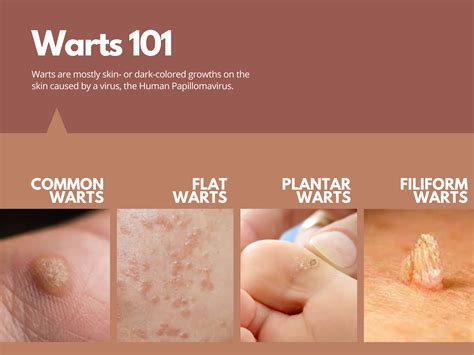 The Derma Corner: The 101 on warts, potential treatments, and how to ...